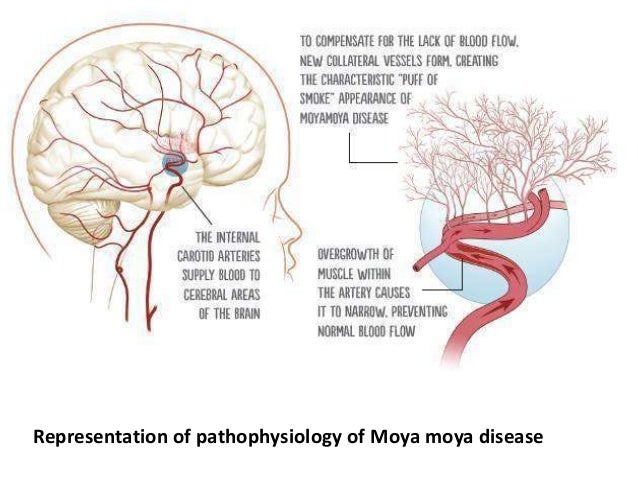 Moya moya disease