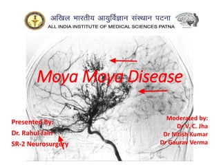 Moya Moya Disease
Presented By:
Dr. Rahul Jain
SR-2 Neurosurgery
Moderated by:
Dr V. C. Jha
Dr Nitish Kumar
Dr Gaurav Verma
 
