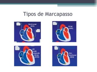 Tipos de Marcapasso
 