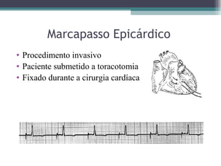 Marcapasso Epicárdico
• Procedimento invasivo
• Paciente submetido a toracotomia
• Fixado durante a cirurgia cardíaca
 