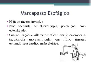 Marcapasso Esofágico
• Método menos invasivo
• Não necessita de fluoroscopia, precauções com
esterilidade.
• Sua aplicação é altamente eficaz em interromper a
taquicardia supraventricular em ritmo sinusal,
evitando-se a cardioversão elétrica.
 