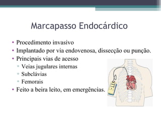 Marcapasso Endocárdico
• Procedimento invasivo
• Implantado por via endovenosa, dissecção ou punção.
• Principais vias de acesso
▫ Veias jugulares internas
▫ Subclávias
▫ Femorais
• Feito a beira leito, em emergências.
 