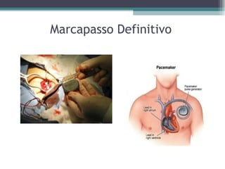 Marcapasso Definitivo
 