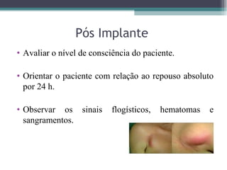 Pós Implante
• Avaliar o nível de consciência do paciente.
• Orientar o paciente com relação ao repouso absoluto
por 24 h.
• Observar os sinais flogísticos, hematomas e
sangramentos.
 