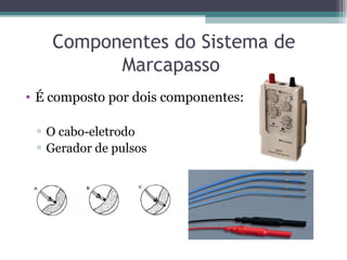 Componentes do Sistema de
Marcapasso
• É composto por dois componentes:
▫ O cabo-eletrodo
▫ Gerador de pulsos
 