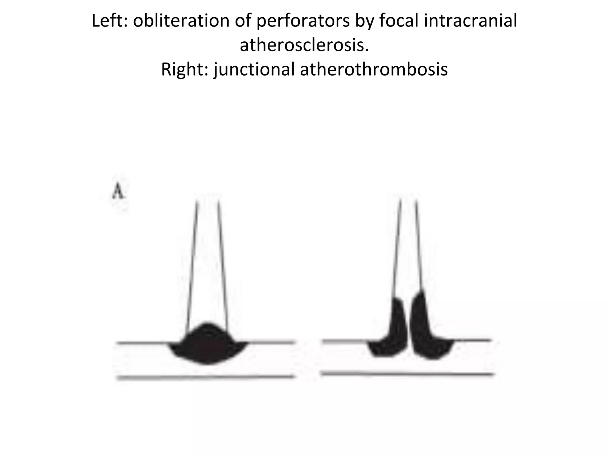 Pathophysiology of ISchemic Stroke | PPTX