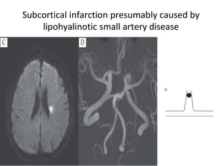 Subchorionic Infarct Pathophysiology of ISchemic Stroke | PPTX