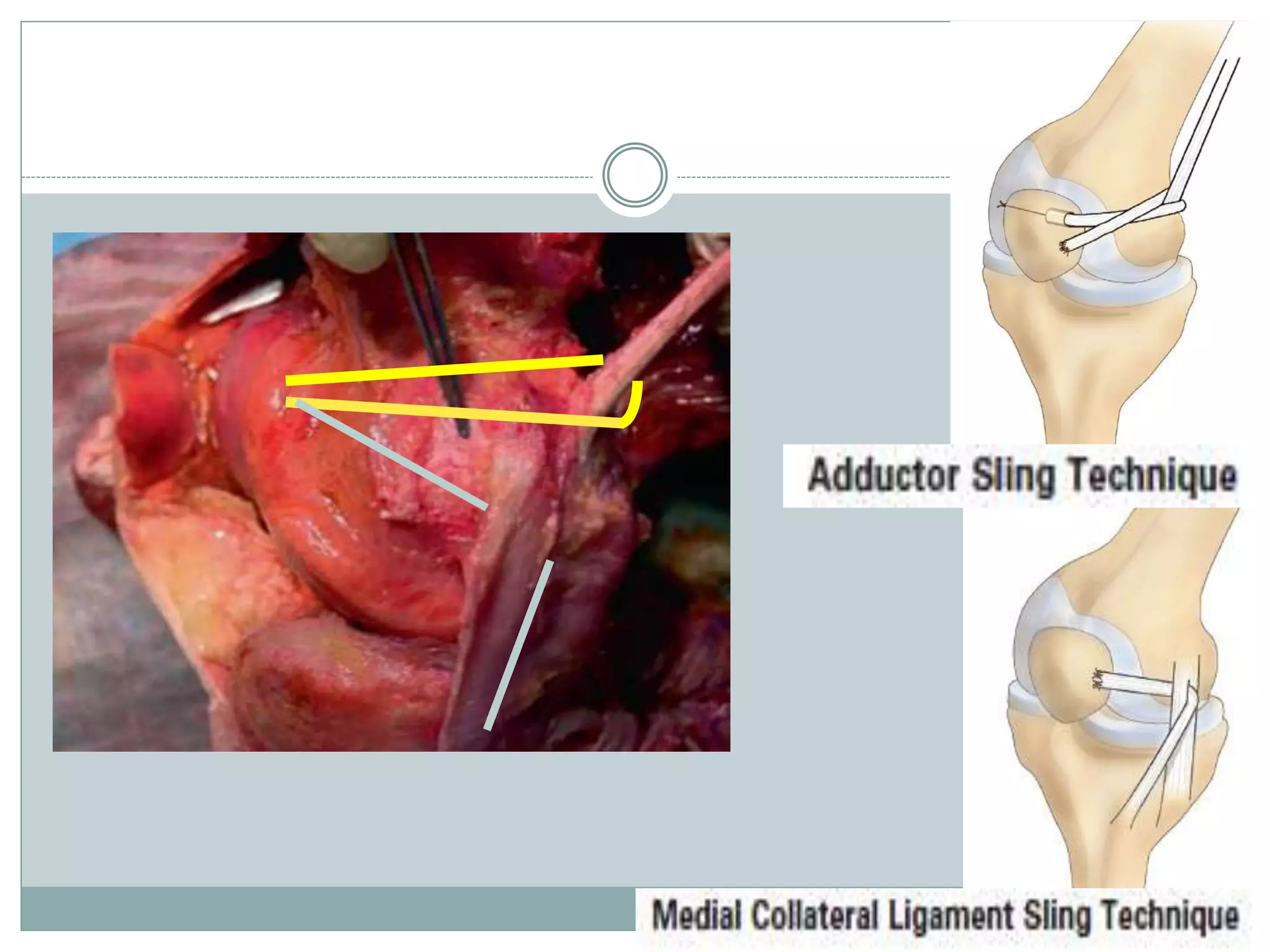 Mpfl Layers Medial Patellofemoral Ligament (MPFL) reconstruction 2014 | PPTX
