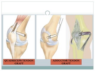 Mpfl Layers Medial Patellofemoral Ligament (MPFL) reconstruction 2014 | PPTX