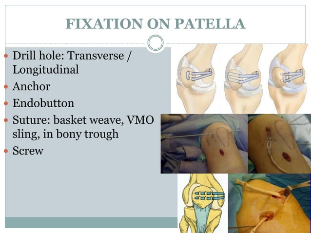 Medial Patellofemoral Ligament (MPFL) reconstruction 2014 | PPTX ...