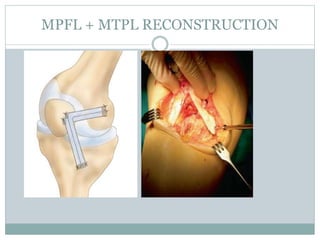 Mpfl Layers Medial Patellofemoral Ligament (MPFL) reconstruction 2014 | PPTX