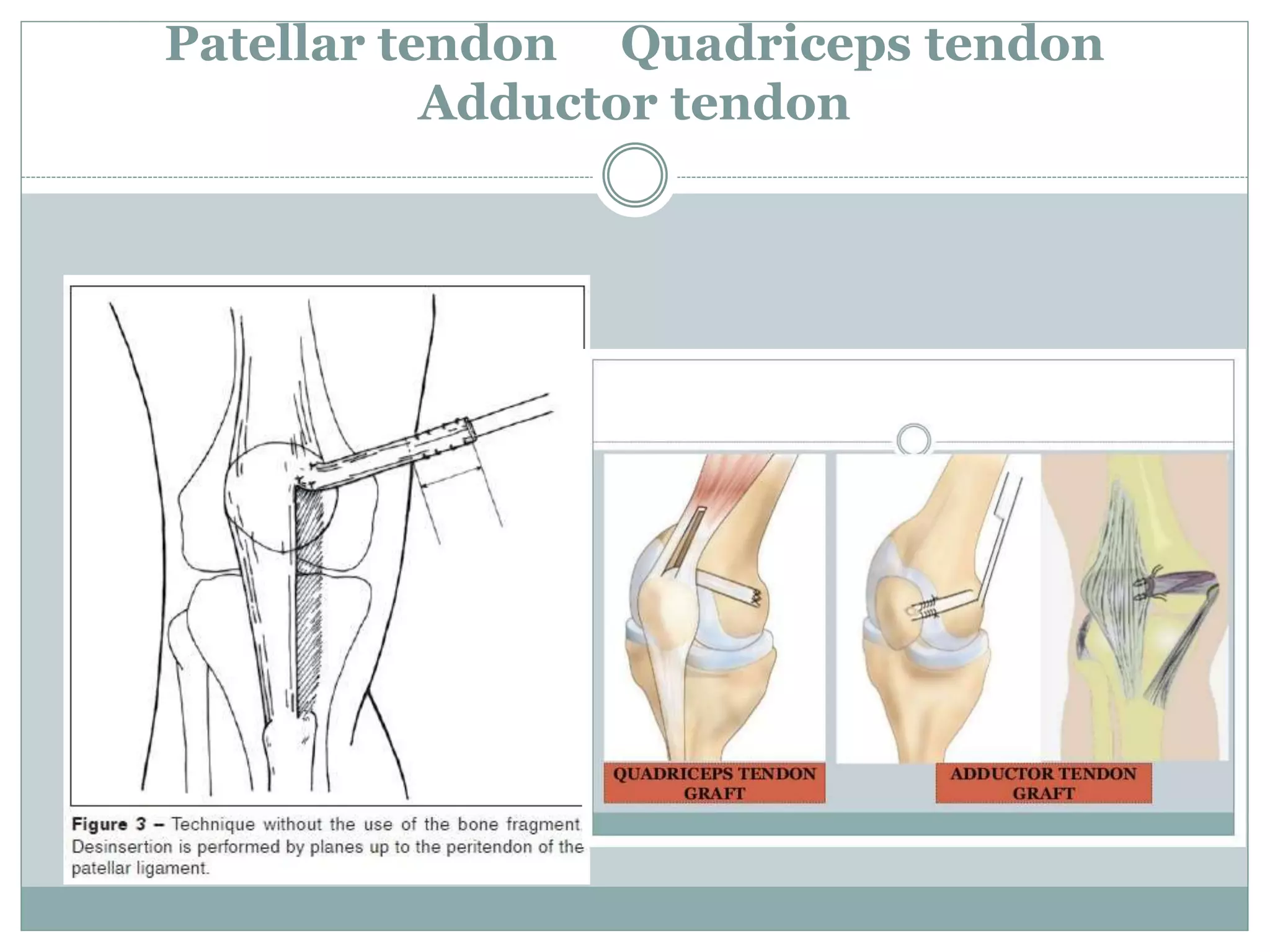 Medial patellofemoral ligament (MPFL) reconstruction | PPTX