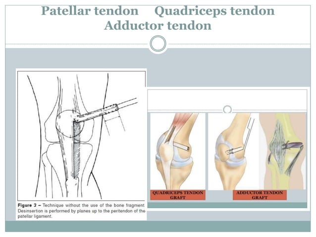 Mpfl Layers Medial patellofemoral ligament (MPFL) reconstruction | PPTX | Death ...