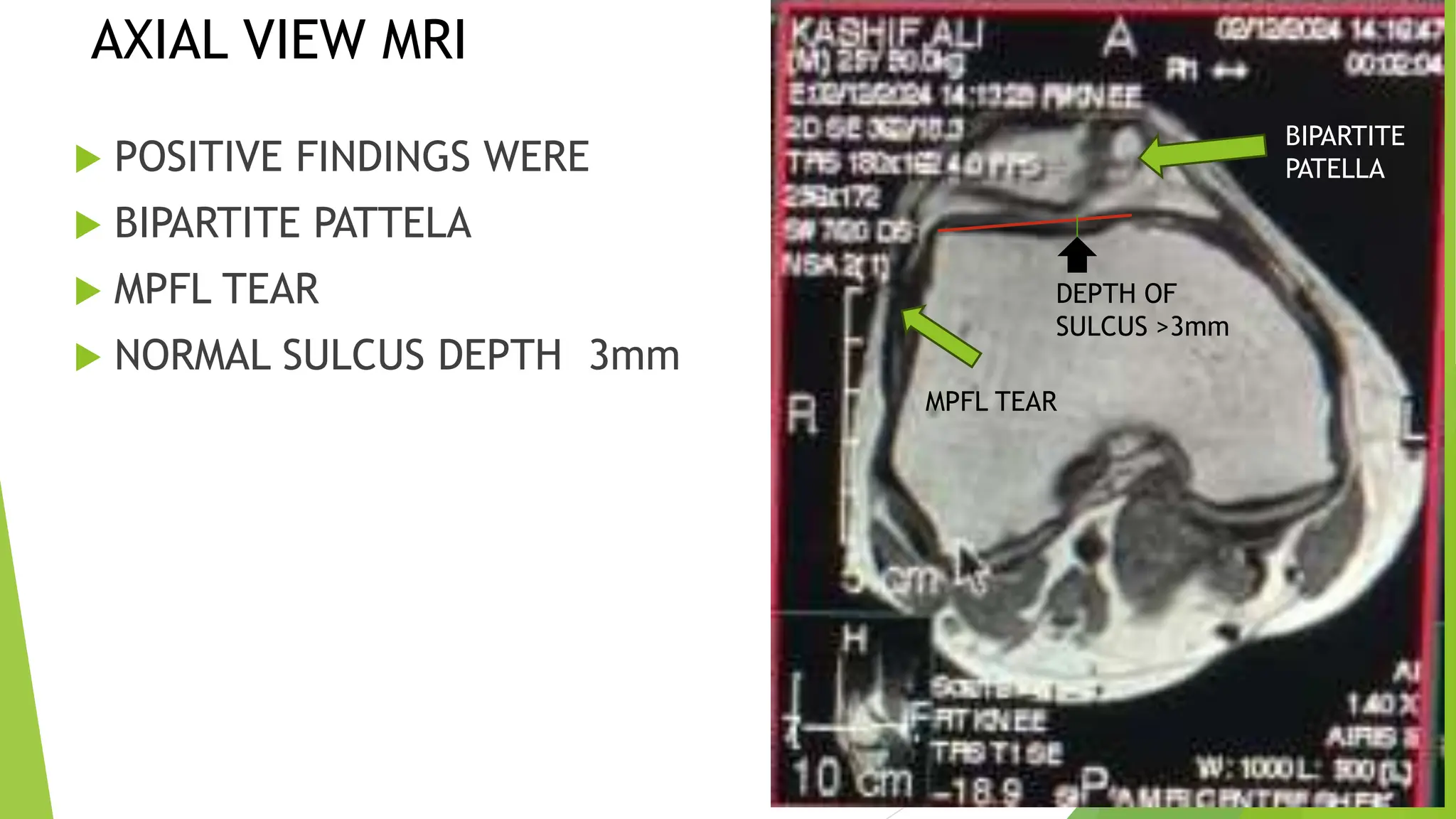 Medial Patello Femoral Ligament MPFL Reconstruction PPTX
