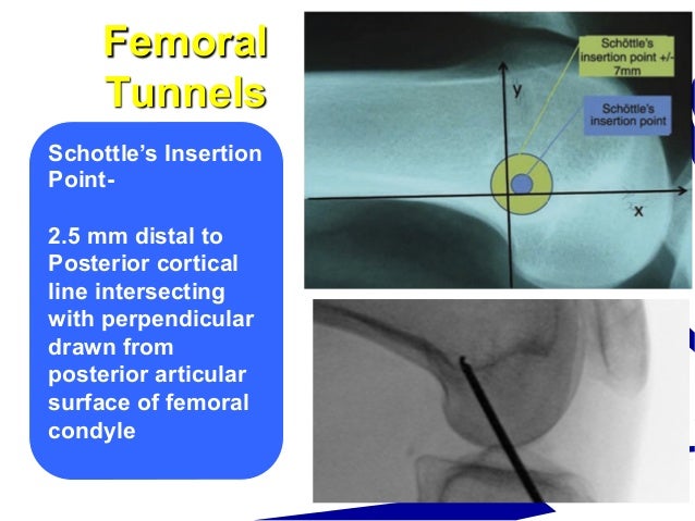 mpfl reconstruction protocol