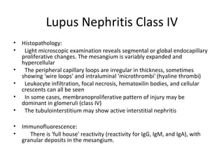 Lupus Nephritis Class IV
• Histopathology:
• Light microscopic examination reveals segmental or global endocapillary
proliferative changes. The mesangium is variably expanded and
hypercellular
• The peripheral capillary loops are irregular in thickness, sometimes
showing 'wire loops' and intraluminal 'microthrombi' (hyaline thrombi)
• Leukocyte infiltration, focal necrosis, hematoxilin bodies, and cellular
crescents can all be seen
• In some cases, membranoproliferative pattern of injury may be
dominant in glomeruli (class IV)
• The tubulointerstitium may show active interstitial nephritis
• Immunofluorescence:
• There is 'full house' reactivity (reactivity for IgG, IgM, and IgA), with
granular deposits in the mesangium.
 