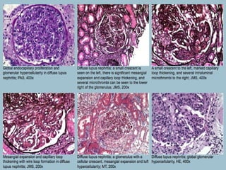 Lupus Nephritis Class IV
 