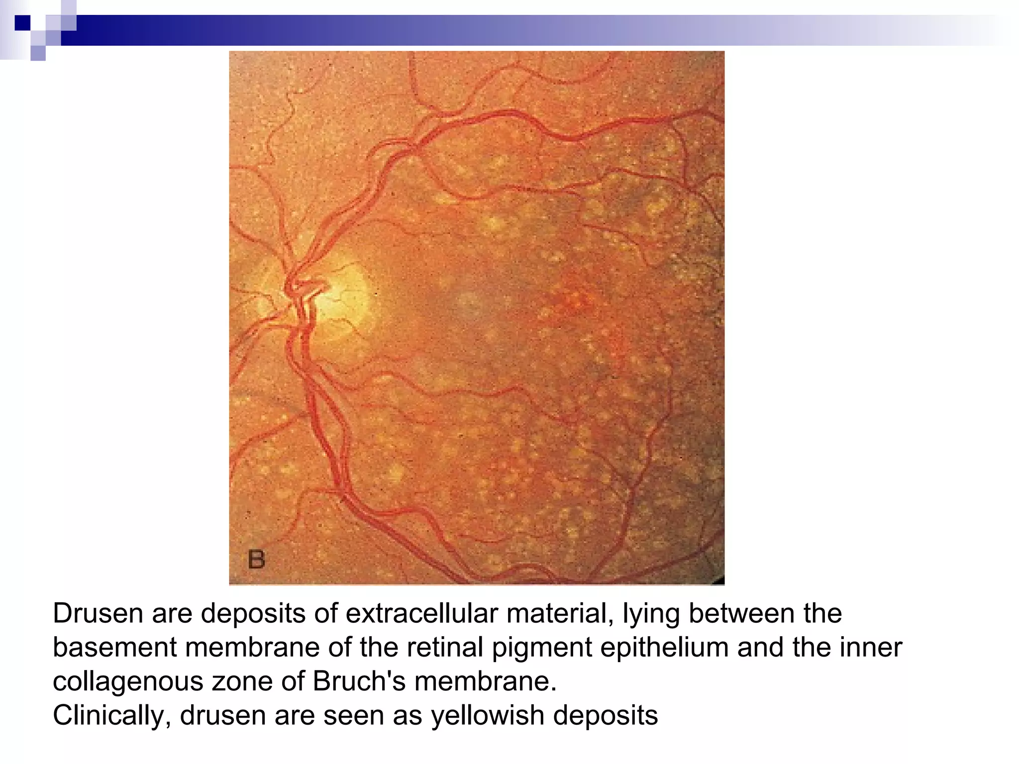 Drusen are deposits of extracellular material, lying between the
basement membrane of the retinal pigment epithelium and the inner
collagenous zone of Bruch's membrane.
Clinically, drusen are seen as yellowish deposits
 