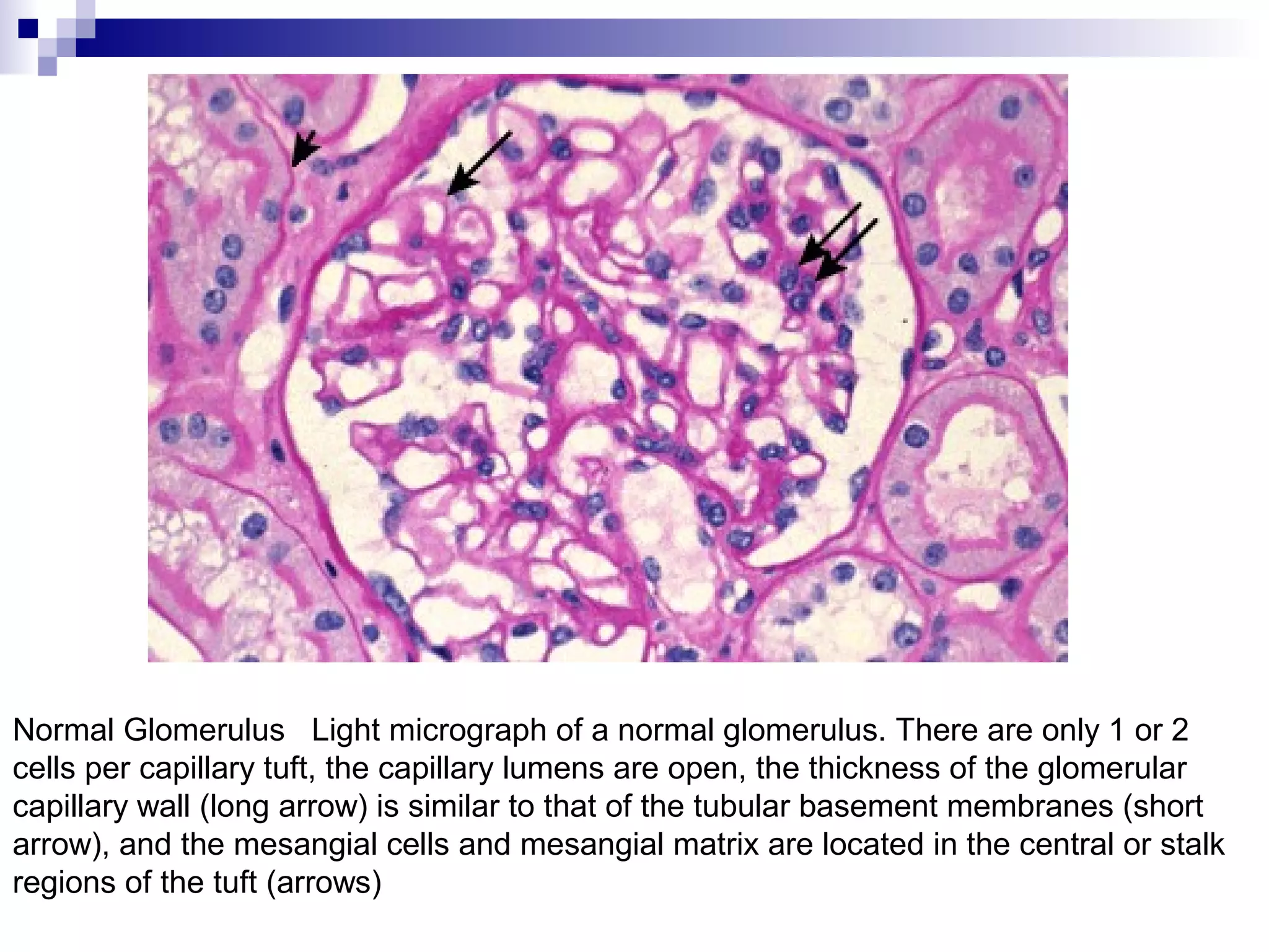 Normal Glomerulus Light micrograph of a normal glomerulus. There are only 1 or 2
cells per capillary tuft, the capillary lumens are open, the thickness of the glomerular
capillary wall (long arrow) is similar to that of the tubular basement membranes (short
arrow), and the mesangial cells and mesangial matrix are located in the central or stalk
regions of the tuft (arrows)
 