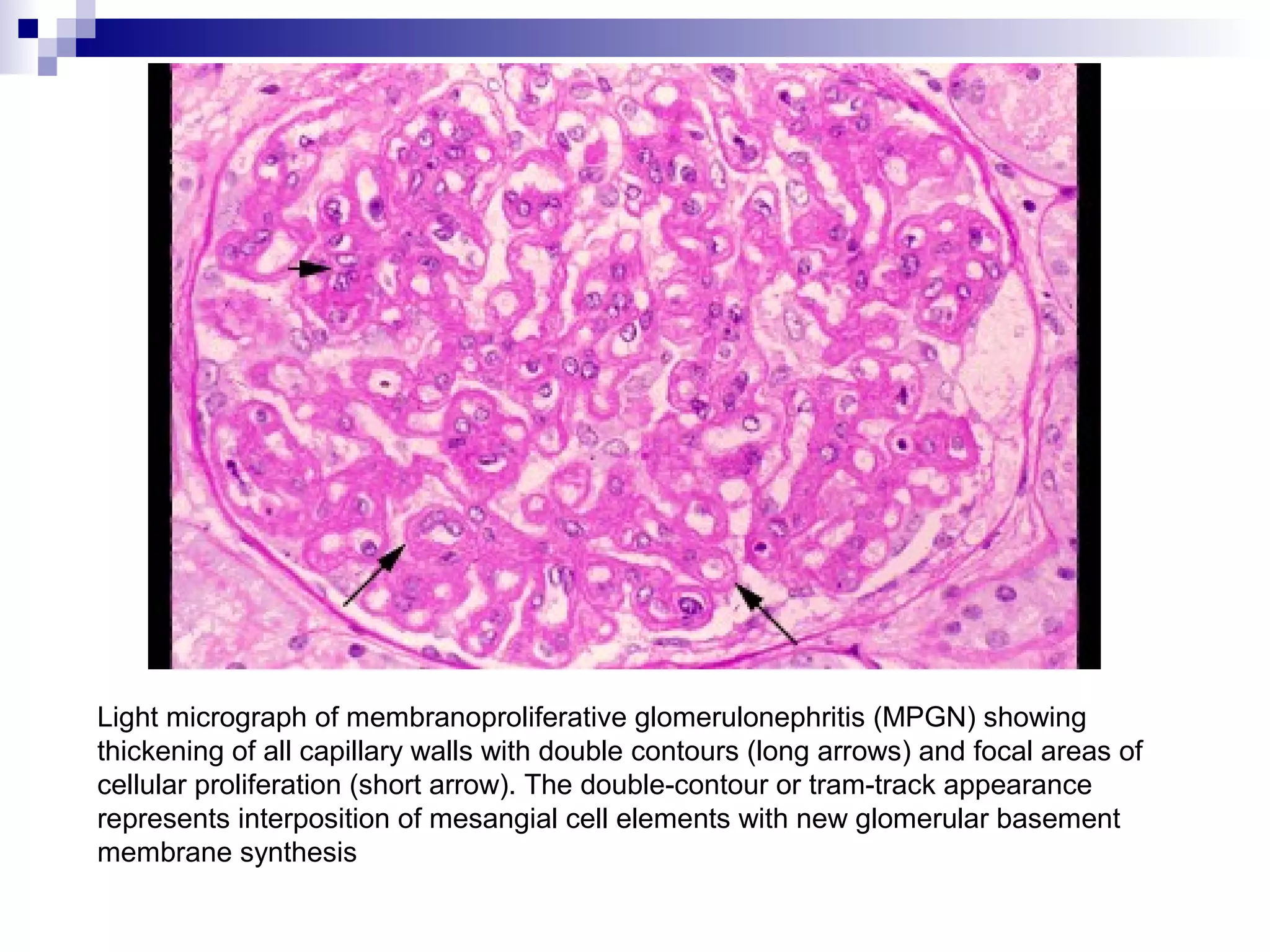 Light micrograph of membranoproliferative glomerulonephritis (MPGN) showing
thickening of all capillary walls with double contours (long arrows) and focal areas of
cellular proliferation (short arrow). The double-contour or tram-track appearance
represents interposition of mesangial cell elements with new glomerular basement
membrane synthesis
 