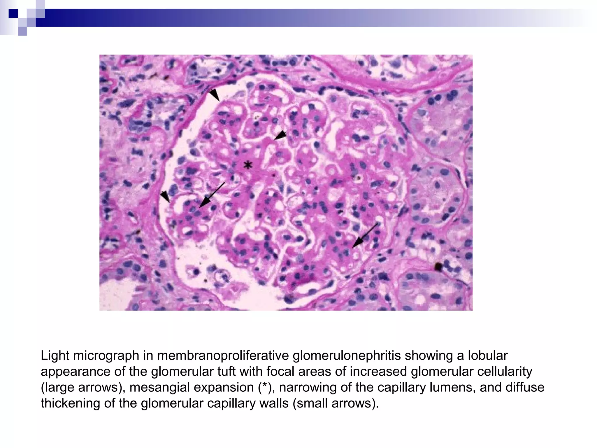 Light micrograph in membranoproliferative glomerulonephritis showing a lobular
appearance of the glomerular tuft with focal areas of increased glomerular cellularity
(large arrows), mesangial expansion (*), narrowing of the capillary lumens, and diffuse
thickening of the glomerular capillary walls (small arrows).
 