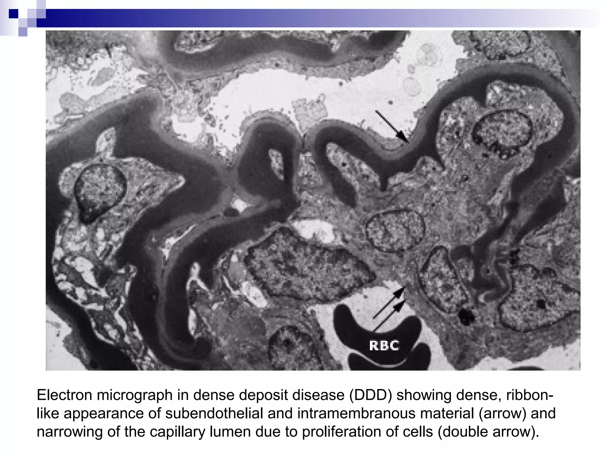 Electron micrograph in dense deposit disease (DDD) showing dense, ribbon-
like appearance of subendothelial and intramembranous material (arrow) and
narrowing of the capillary lumen due to proliferation of cells (double arrow).
 
