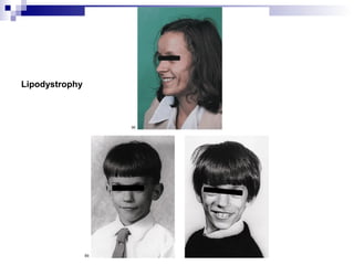Lipodystrophy
 