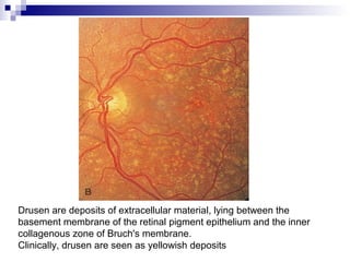 Drusen are deposits of extracellular material, lying between the
basement membrane of the retinal pigment epithelium and the inner
collagenous zone of Bruch's membrane.
Clinically, drusen are seen as yellowish deposits
 