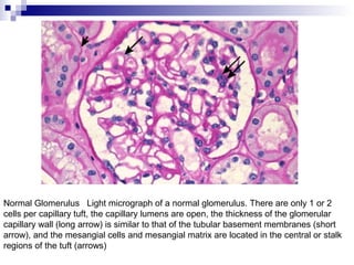 Normal Glomerulus Light micrograph of a normal glomerulus. There are only 1 or 2
cells per capillary tuft, the capillary lumens are open, the thickness of the glomerular
capillary wall (long arrow) is similar to that of the tubular basement membranes (short
arrow), and the mesangial cells and mesangial matrix are located in the central or stalk
regions of the tuft (arrows)
 
