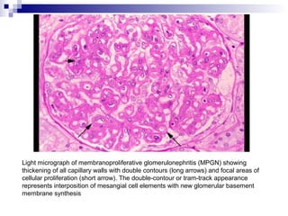 Light micrograph of membranoproliferative glomerulonephritis (MPGN) showing
thickening of all capillary walls with double contours (long arrows) and focal areas of
cellular proliferation (short arrow). The double-contour or tram-track appearance
represents interposition of mesangial cell elements with new glomerular basement
membrane synthesis
 