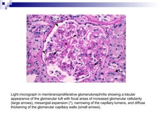 Light micrograph in membranoproliferative glomerulonephritis showing a lobular
appearance of the glomerular tuft with focal areas of increased glomerular cellularity
(large arrows), mesangial expansion (*), narrowing of the capillary lumens, and diffuse
thickening of the glomerular capillary walls (small arrows).
 