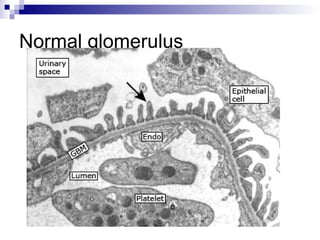 Normal glomerulus
 