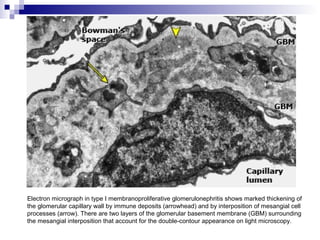 Electron micrograph in type I membranoproliferative glomerulonephritis shows marked thickening of
the glomerular capillary wall by immune deposits (arrowhead) and by interposition of mesangial cell
processes (arrow). There are two layers of the glomerular basement membrane (GBM) surrounding
the mesangial interposition that account for the double-contour appearance on light microscopy.
 
