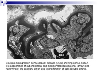 Electron micrograph in dense deposit disease (DDD) showing dense, ribbon-
like appearance of subendothelial and intramembranous material (arrow) and
narrowing of the capillary lumen due to proliferation of cells (double arrow).
 