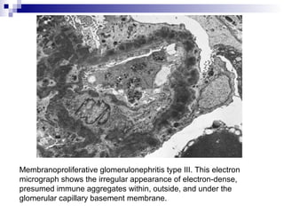 Membranoproliferative glomerulonephritis type III. This electron
micrograph shows the irregular appearance of electron-dense,
presumed immune aggregates within, outside, and under the
glomerular capillary basement membrane.
 