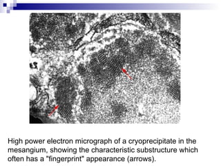 High power electron micrograph of a cryoprecipitate in the
mesangium, showing the characteristic substructure which
often has a "fingerprint" appearance (arrows).
 