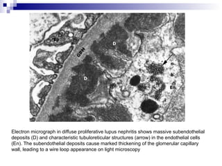 Electron micrograph in diffuse proliferative lupus nephritis shows massive subendothelial
deposits (D) and characteristic tubuloreticular structures (arrow) in the endothelial cells
(En). The subendothelial deposits cause marked thickening of the glomerular capillary
wall, leading to a wire loop appearance on light microscopy
 