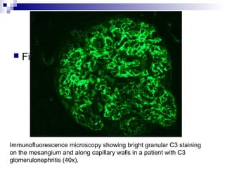 Immunofluorescence microscopy showing bright granular C3 staining
on the mesangium and along capillary walls in a patient with C3
glomerulonephritis (40x).
 Fig
 