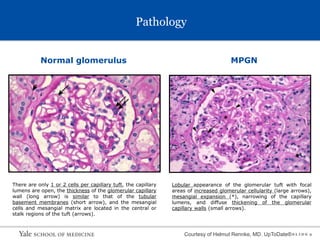 S L I D E 9
Pathology
Normal glomerulus MPGN
There are only 1 or 2 cells per capillary tuft, the capillary
lumens are open, the thickness of the glomerular capillary
wall (long arrow) is similar to that of the tubular
basement membranes (short arrow), and the mesangial
cells and mesangial matrix are located in the central or
stalk regions of the tuft (arrows).
Lobular appearance of the glomerular tuft with focal
areas of increased glomerular cellularity (large arrows),
mesangial expansion (*), narrowing of the capillary
lumens, and diffuse thickening of the glomerular
capillary walls (small arrows).
Courtesy of Helmut Rennke, MD. UpToDate®
 