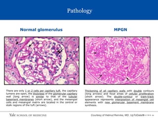 S L I D E 10
Pathology
Normal glomerulus MPGN
There are only 1 or 2 cells per capillary tuft, the capillary
lumens are open, the thickness of the glomerular capillary
wall (long arrow) is similar to that of the tubular
basement membranes (short arrow), and the mesangial
cells and mesangial matrix are located in the central or
stalk regions of the tuft (arrows).
Thickening of all capillary walls with double contours
(long arrows) and focal areas of cellular proliferation
(short arrow). The double-contour or tram-track
appearance represents interposition of mesangial cell
elements with new glomerular basement membrane
synthesis.
Courtesy of Helmut Rennke, MD. UpToDate®
 
