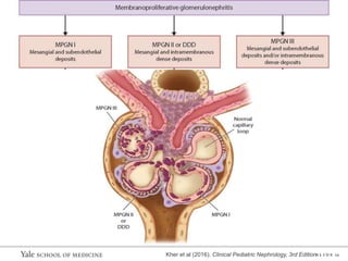 S L I D E 12
Kher et al (2016). Clinical Pediatric Nephrology, 3rd Edition
 