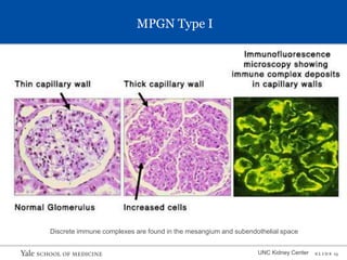 S L I D E 13
MPGN Type I
UNC Kidney Center
Discrete immune complexes are found in the mesangium and subendothelial space
 