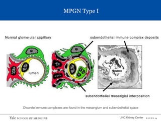 S L I D E 14
MPGN Type I
UNC Kidney Center
Discrete immune complexes are found in the mesangium and subendothelial space
 