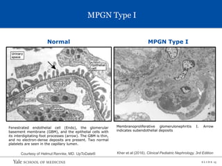 S L I D E 15
MPGN Type I
Normal MPGN Type I
Fenestrated endothelial cell (Endo), the glomerular
basement membrane (GBM), and the epithelial cells with
its interdigitating foot processes (arrow). The GBM is thin,
and no electron-dense deposits are present. Two normal
platelets are seen in the capillary lumen.
Courtesy of Helmut Rennke, MD. UpToDate® Kher et al (2016). Clinical Pediatric Nephrology, 3rd Edition
Membranoproliferative glomerulonephritis I. Arrow
indicates subendothelial deposits
 
