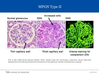 S L I D E 16
MPGN Type II
This is also called dense deposit disease. When viewed under the microscope, continuous, dense ribbon-like
deposits are found along the basement membranes of the glomeruli, tubules, and Bowman’s capsule
 