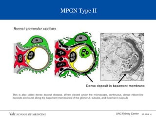 S L I D E 17
MPGN Type II
UNC Kidney Center
This is also called dense deposit disease. When viewed under the microscope, continuous, dense ribbon-like
deposits are found along the basement membranes of the glomeruli, tubules, and Bowman’s capsule
 