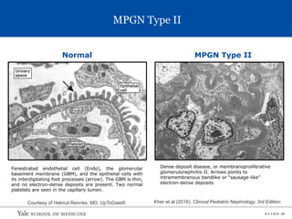 S L I D E 18
MPGN Type II
Normal MPGN Type II
Fenestrated endothelial cell (Endo), the glomerular
basement membrane (GBM), and the epithelial cells with
its interdigitating foot processes (arrow). The GBM is thin,
and no electron-dense deposits are present. Two normal
platelets are seen in the capillary lumen.
Courtesy of Helmut Rennke, MD. UpToDate® Kher et al (2016). Clinical Pediatric Nephrology, 3rd Edition
Dense deposit disease, or membranoproliferative
glomerulonephritis II. Arrows points to
intramembranous bandlike or “sausage-like”
electron-dense deposits
 