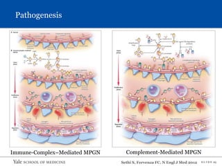 S L I D E 25
Sethi S, Fervenza FC. N Engl J Med 2012
Immune-Complex–Mediated MPGN Complement-Mediated MPGN
Pathogenesis
 