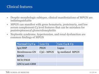 S L I D E 26
Clinical features
• Despite morphologic subtypes, clinical manifestations of MPGN are
indistinguishable
• MPGN can manifest with gross hematuria, proteinuria, and low
serum complement C3 level features that can be mistaken for
poststreptococcal glomerulonephritis
• Nephrotic syndrome, hypertension, and renal dysfunction are
common findings of MPGN
Normal C3/C4 Low C3 Low C4 & C3
IgA/HSP PIGN Lupus
Membranous GN C3G - MPGN Ig-mediated MPGN
RPGN
MCD/FSGS
ANCA/anti-GBM
 