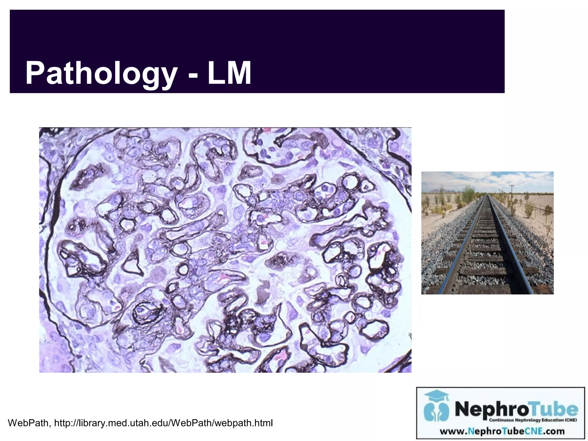 Webpath Pdf Membranoproliferative GN - Road to Diagnosis & Management - What is the ...